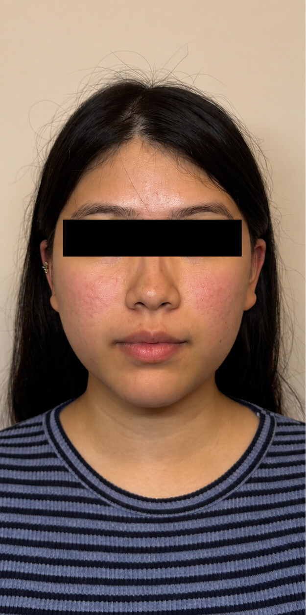 Before a MUKA treatment, result two