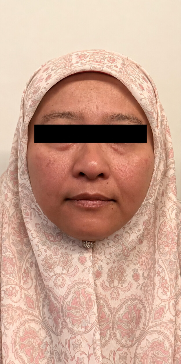Before a MUKA treatment, result three